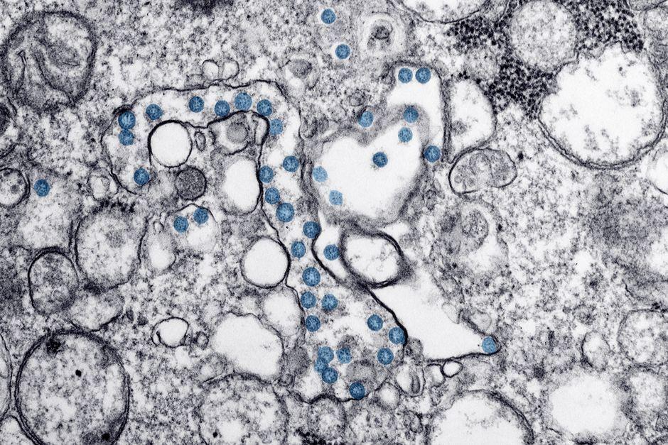 As US Measles Cases Rise, Biotech Firms Start Developing New Treatments